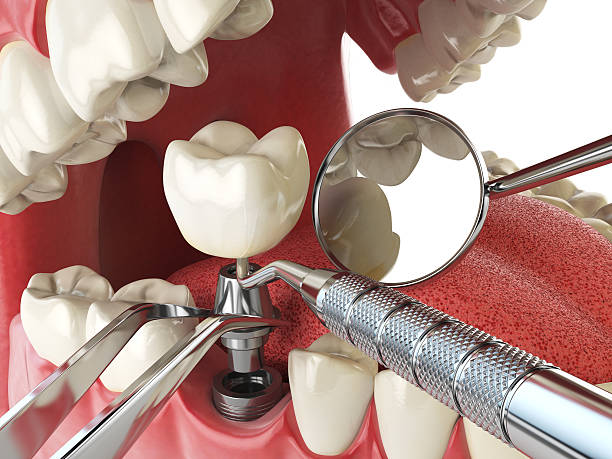 Best Emergency Root Canal Treatment in Modesto, CA